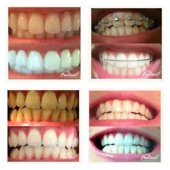 teeth whitening image